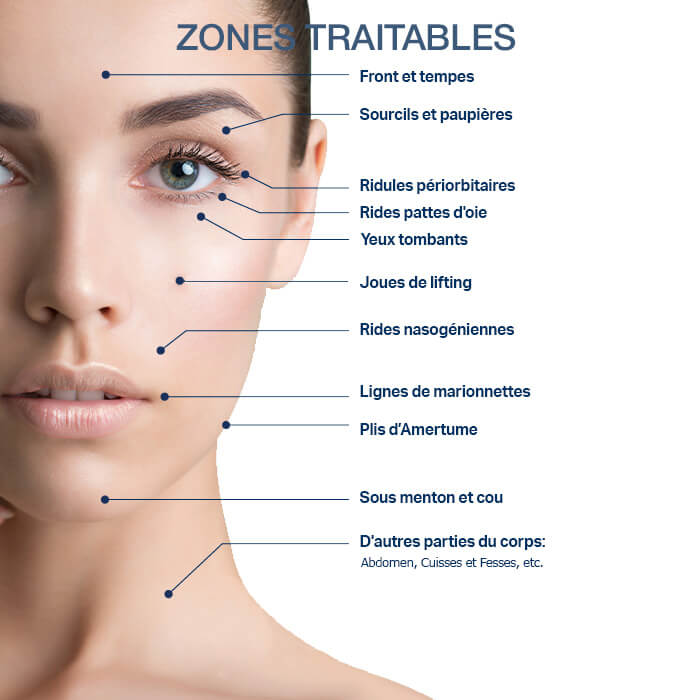 Zones traitables pour le lifting du visage RF chez Salon Toujours Belle